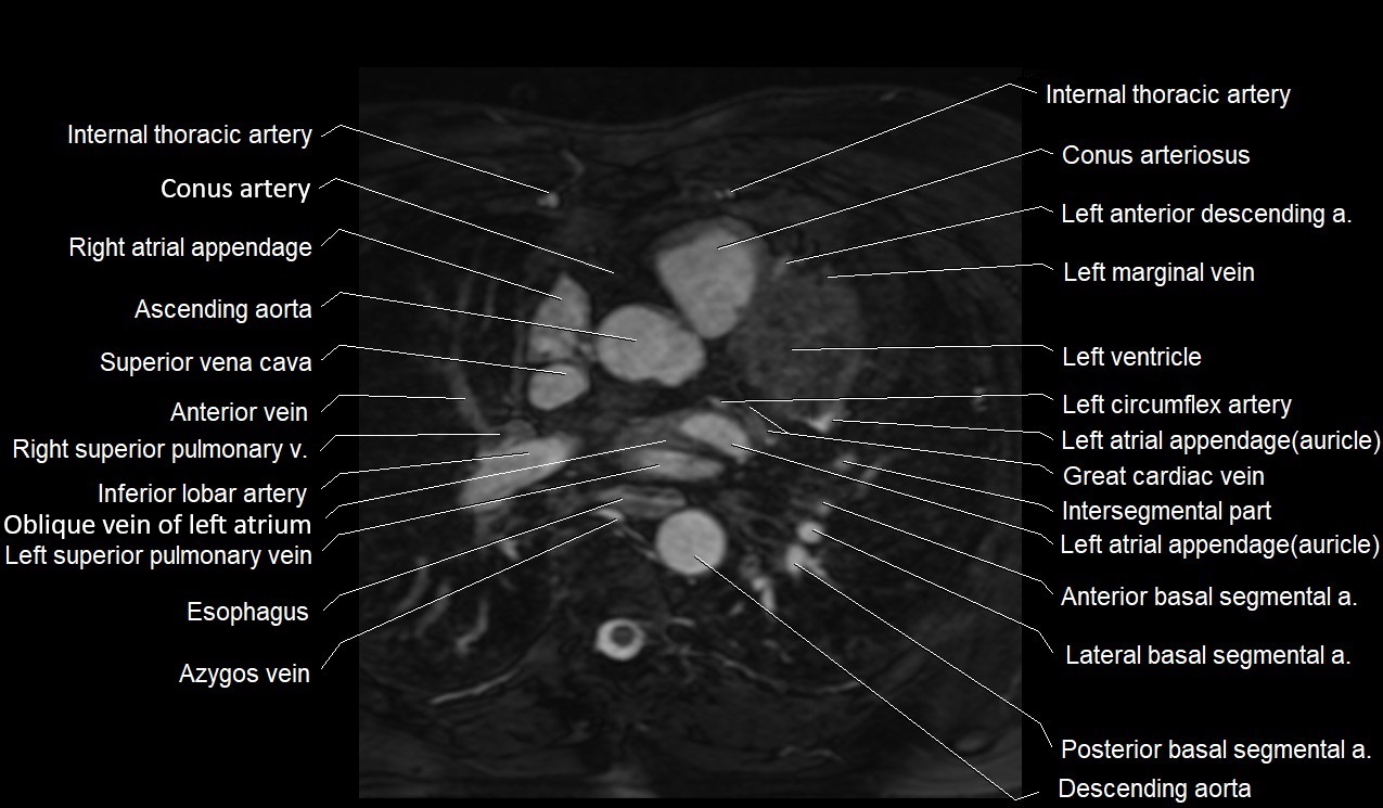 MRI heart coronary arteries and coronary veins anatomy axial image 14.jpg